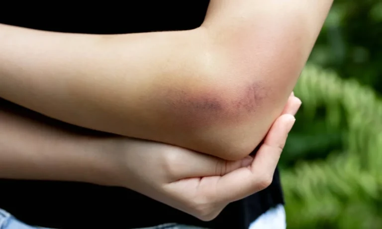 dreams-about-bruises-on-arms